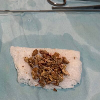 Спасли единственную почку